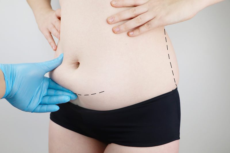 tummy tuck and liposuction