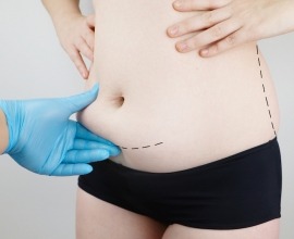 tummy tuck