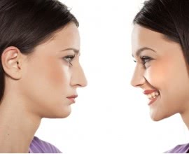 Rhinoplasty (Nose Surgery) - Costs Both Financial and Aesthetic