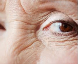 Blepharoplasty: A Short Surgery to Get Rid of Your Eye Wrinkles Long-term