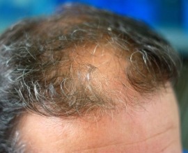 hair loss