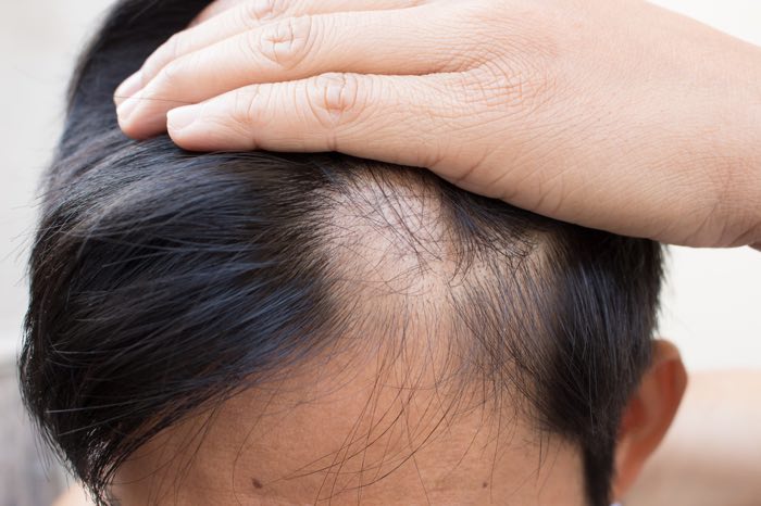alopecia areata