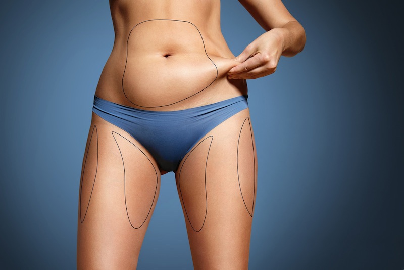 liposuction