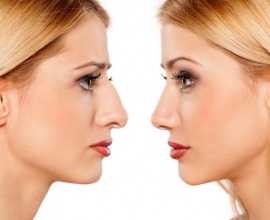 rhinoplasty