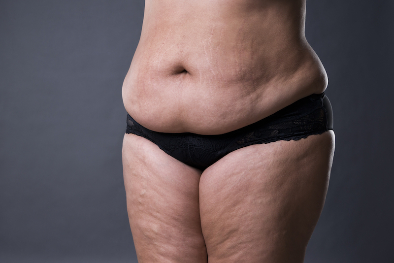 abdominal liposuction