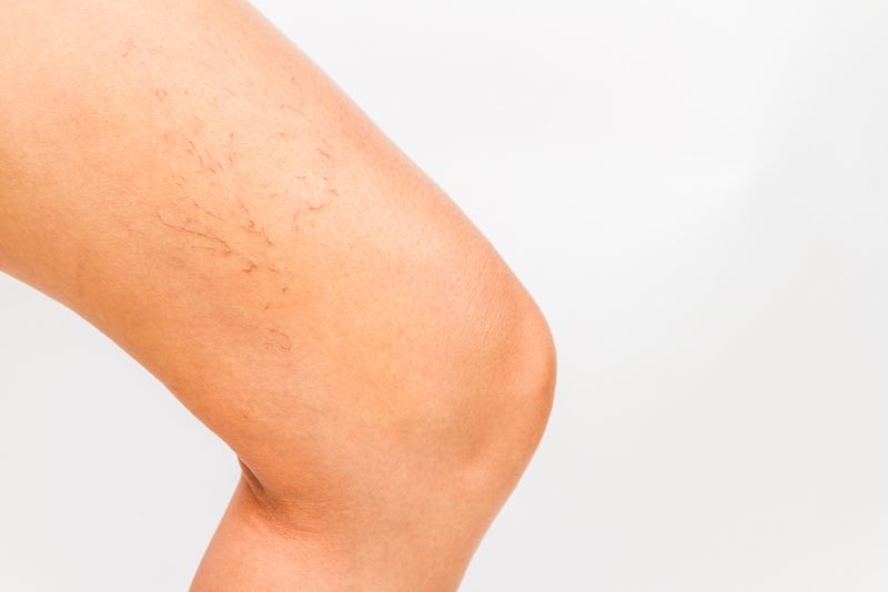 varicose vein treatment