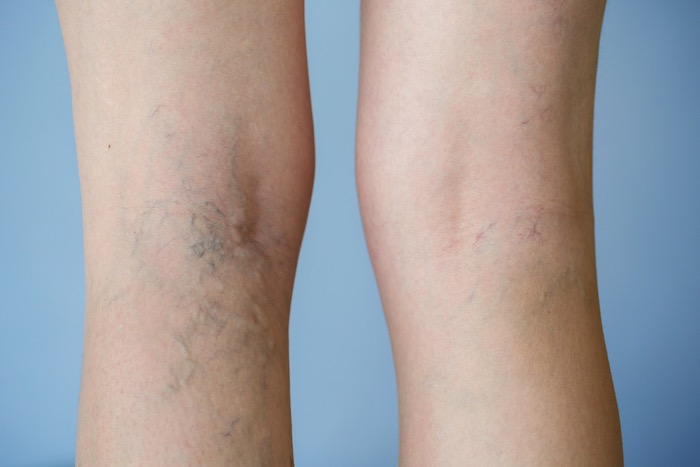 varicose veins