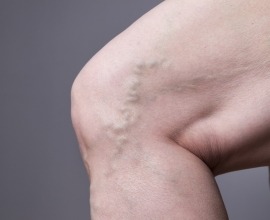 varicose veins
