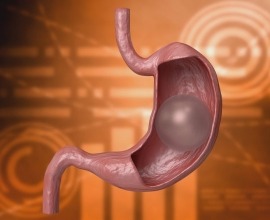 Gastricballoon