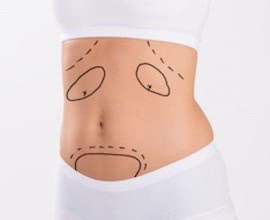 Wie ist es mit Sport, Baden und Urlauben am See nach einer Bauchdeckenstraffung/Fettabsaugung?