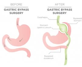 Unterschiede zwischen Magenballon und Magenbypass (warum ist Magenballon besser?)